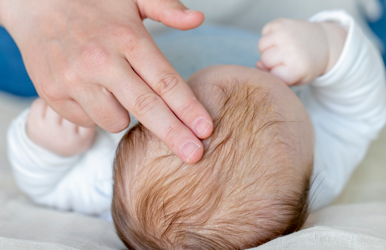 Baby mit Milchschorf oder Kopfgneis