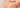 Lipödem – Basiscreme für die Hautpflege nach der Liposuktion